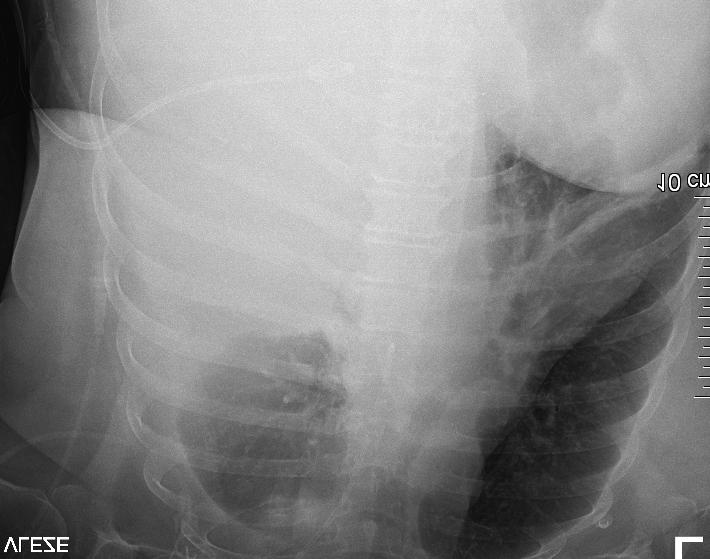 Vykašlané sputum pak bylo nezvykle syté žluté barvy. Akutní bronchoskopie potvrdila masivní kontaminaci žlučí již pod hlasivkovými vazy. 6.