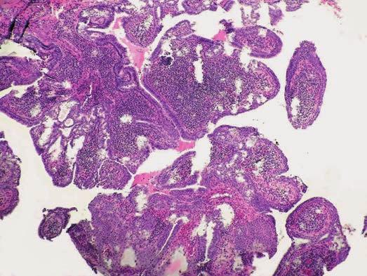 V mikroskopickom obraze dominovala v teréne sebaceózneho névu vliačená epiderma s exofyticky rastúcim benígnym adnexálnym nádorom (obr. 1 a 2).