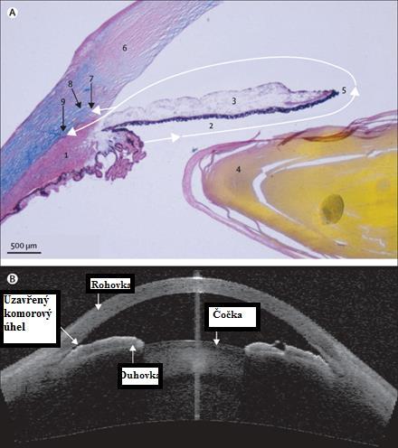 Obrázek 2 (A) Histologický snímek zdravého oka - normální směr toku nitrooční tekutiny (1) Zadní komora, místo produkce nitrooční tekutiny (2) subsklerální prostor mezi duhovkou a rohovkou (3) zadní