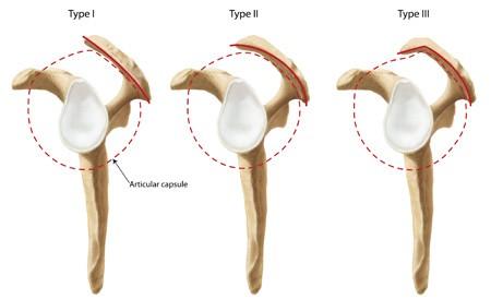 Anteriosuperior impingement Impingement pod korakoakromiálním obloukem