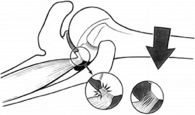 Posteriosuperior impingement Impingement mezi intrartikulární částí m.