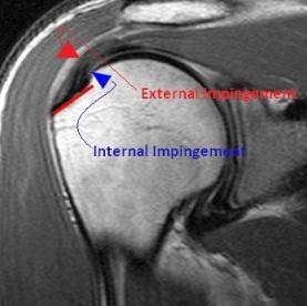Anteriointernal impingement Gerber