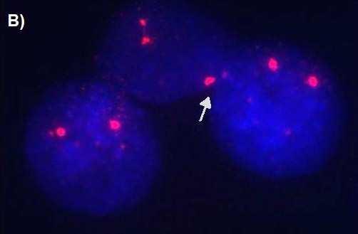 5.4 Hodnocení FISH preparátů Při hodnocení FISHových preparátu by měla být věnována pozornost rozložení metafázích chromozomů, nebo interfázních jader v zorném poli mikroskopu.