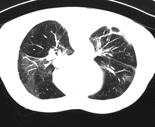 4: CT hrudníku oboustranná covid-19 pneumonie,