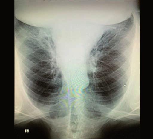 podle potřeby. Pacient byl edukován v inhalační technice k použití inhalačního systému Breezhaler a aerosolového dávkovače a byl upozorněn na edukační internetové stránky www.mujinhalator.cz.