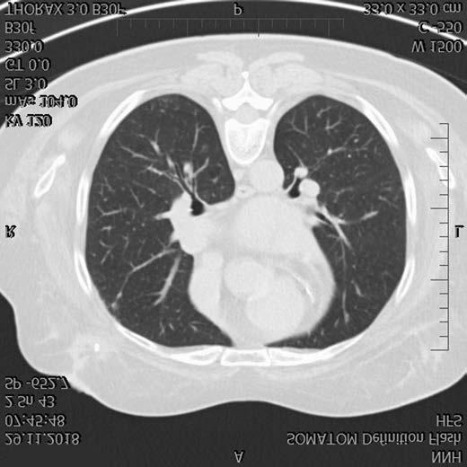 Obr. 3: Bronchoskopický nález difuzního endobronchiálního krvácení při DAH Obr.