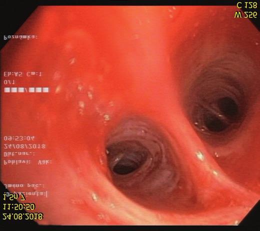 časně přistoupili k provedení totální tyreoidektomie. Operační výkon proběhl bez komplikací. Histologické vyšetření prokázalo toxickou strumu s výraznou chronickou produktivní tyreoiditidou.