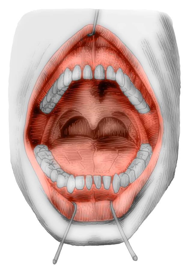 DUTINA ÚSTNÍ VESTIBULUM ORIS CAVITAS ORIS PROPRIA PALATUM ARCUS PALATOGLOSSUS TONSILLAE