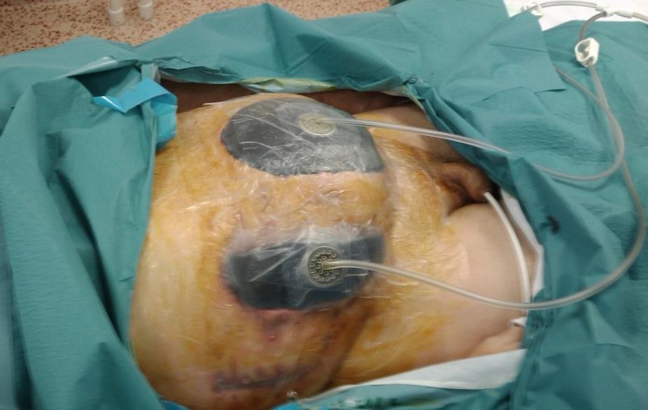 Chirurgická léčba spočívá v revizi dutiny břišní s odstraněním nekrotických tkání, s maximálním šetřením vitální tkáně, v peroperačním výplachu a založení drénů pro další laváž omentální burzy, tedy