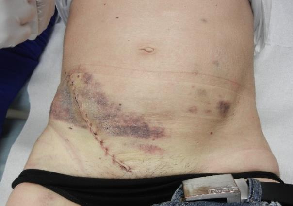 Umístění štěpu se provádí heterotopicky do jámy kyčelní (cévy se připojí na ilickou tepnu a žílu, ureter se všije do močového měchýře).