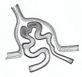 Syndrom krátkého střeva trhliny (fisury) Ulcerosní kolitida vřed (ulcus) (SBS, short bowel syndrome) je charakterizován snížením funkční plochy střeva pod minimum potřebné k trávení a vstřebávání