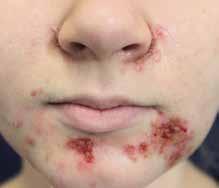 POSTGRADUÁLNÍ VZDĚLÁVÁNÍ KOREKTIVNÍ DERMATOLOGIE preparáty s obsahem některých koagulačních faktorů (fibrin, trombin).