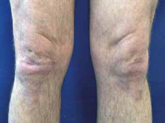 4 Stav po 6 týdnech léčby adalimumabem diagnózy zvažovat další dermatózy (seboroická dermatitida, tinea, lichen simplex