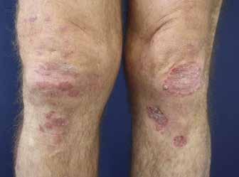 Histopatologické vyšetření postižené kůže v případě psoriázy ukáže specifické změny (hyperkeratóza a parakeratóza