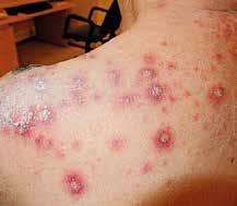 KAZUISTIKA tí na oxacilin, klindamycin, cefalotin, tetracyklin, trimetoprim + sulfonamid. Výtěr z krku: Streptococcus beta-haemolyticus bez určení skupiny s citlivostí na penicilin a erytromycin.