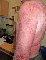 Ve spolupráci s chirurgickým oddělením byly odebrány dva vzorky z oblasti pravého ramene a paže k dermatohistologickému vyšetření a odeslány do Bioptické laboratoře Plzeň, kde histologický vzorek