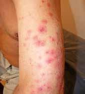 Hypoteticky by bylo možné brát v úvahu i případný Koebnerův fenomén v místě seboroické veruky, náležející např. lupus erythematodes subacutus.