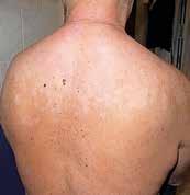 Po klinicko-patologické korelaci uzavíráme jako lupus erythematodes subacutus. Pacient byl na vlastní přání dimitován 8.