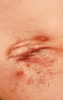 SUCCUS OTEVŘENÁ STUDIE S ANAKINROU V LÉČBĚ MÍRNÉ AŽ TĚŽKÉ HIDRADENITIS SUPPURATIVA Hidradenitis suppurativa je chronické zánětlivé onemocnění charakterizované vznikem sterilních abscesů a fistul v