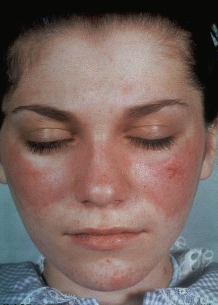 Klinický scénář 1 19letá žena bolesti drobných kloubů únavový syndrom vyrážku v obličeji respiračně vázané bolesti v pravém hemithoraxu.