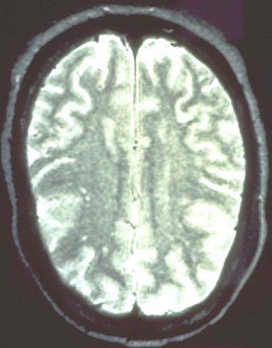 SLE MRI mozku, T2 obraz
