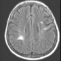 MRI mozku u 43-leté pacientky s NPSLE Ložiskové