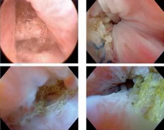 Obr. 1. Velký hematom jako komplikace implantace syntetického slingu v léčbě ženské stresové močové inkontinence vyžadující chirurgickou drenáž. V diskusi MUDr.