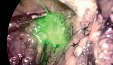 VEILND (video endoscopic inguinal lymph node dissection) s fluorescenčním značením sentinelových uzlin indocyaninovou zelení (ICG) u karcinomu penisu pt1g2 a cn0 Prof.