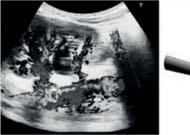 Laparoskopická transpozice aberantních cév ( vascular hitch ) u obstrukce pyeloureterální junkce (PUJ) Doc. MUDr. Radim Kočvara, FEAPU, Oddělení dětské urologie, Urologická klinika VFN a 1.
