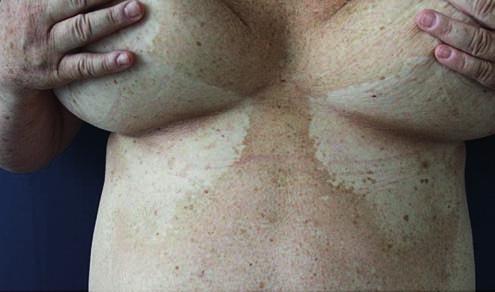 hypopigmentace