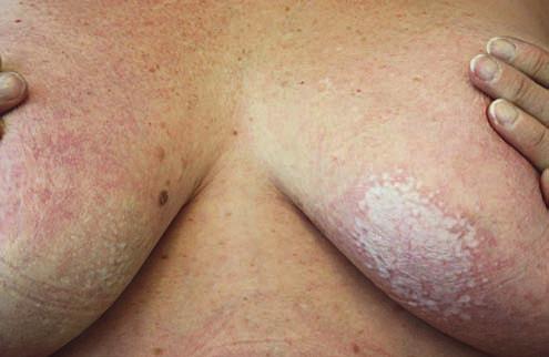 sclerosus et