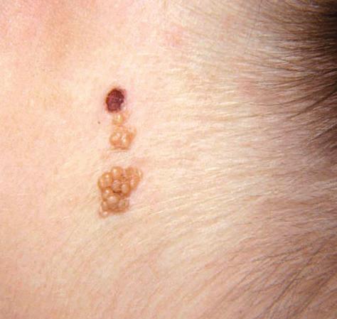 Patří sem: nevus sebaceus, epidermální névus, lineární epidermolytická hyperkeratóza, zánětlivý lineární verukózní epidermální névus (ILVEN inflammatory linear verrucous epidermal nevus), lineární