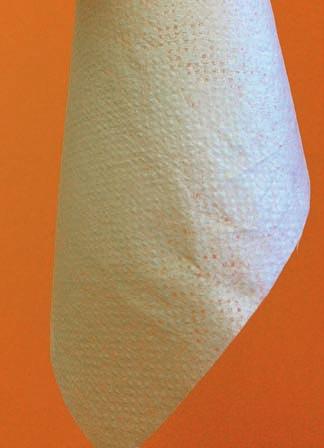 Na Oddělení ÚČOCH byla provedena excize rezistence v rozsahu 2krát 3 cm s krytím pomocí PCL nanovláken (Obr. 10) s Hyiodine gelem (Obr. 9B) a s krytím Mepilexem Ag (Obr.