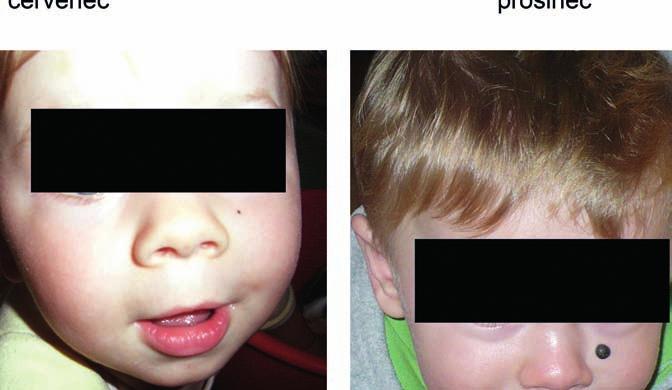 DERMATOLOGIE A OSTATNÍ OBORY některé z nich jsou specifické pro onkologii, jiné se mohou objevit u kteréhokoli dítěte (Tab. 1).