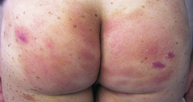 DERMATOLOGIE A OSTATNÍ OBORY Obr. 3 Mycosis fungoides (materiál KDO FN Brno) a sluneční záření u predisponovaných (1, 11, 12) jedinců.