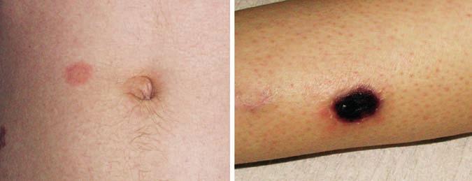 DERMATOLOGIE A OSTATNÍ OBORY typických charakteristikách a v průběhu let byla vlivem nových poznatků opakovaně inovována a měněna.