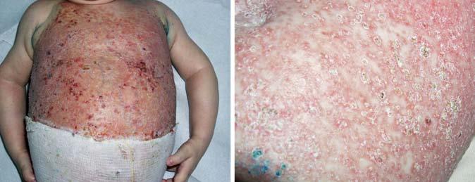 Jednou z nejčastějších forem kožních lymfomů u dospělých je mycosis fungoides (MF tvoří téměř 65 % všech primárních kožních lymfomů) (Obr. 3). U dětí představuje pouze 4 5 % kožních NHL.