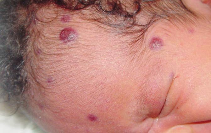 DERMATOLOGIE A OSTATNÍ OBORY ložiska (Obr. 6). Méně často jsou postiženy vnitřní orgány (plíce, játra, ledviny, (1, 26) střevo, slezina). Lokalizovaný kožní JXG je obvykle tzv.