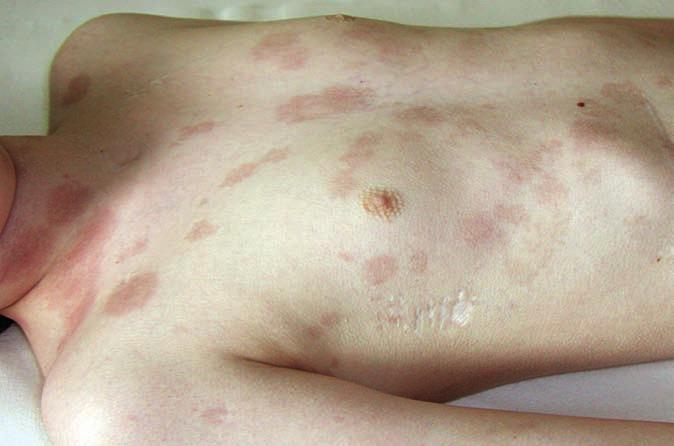 7 Leukemické infiltráty kůže (materiál KDO FN Brno) Metastatické postižení kůže u jiných typů nádorů je obvykle projevem generalizace nemoci.