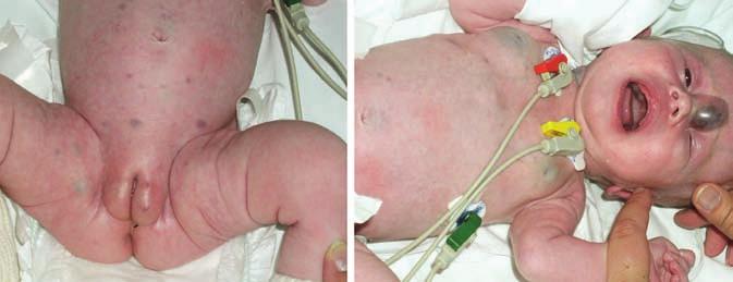 Ze solidních nádorů nejčastěji metastazuje do kůže neuroblastom v podobě tmavě zbarvených nodulů (tzv. blueberry muffin baby) (Obr. 8).