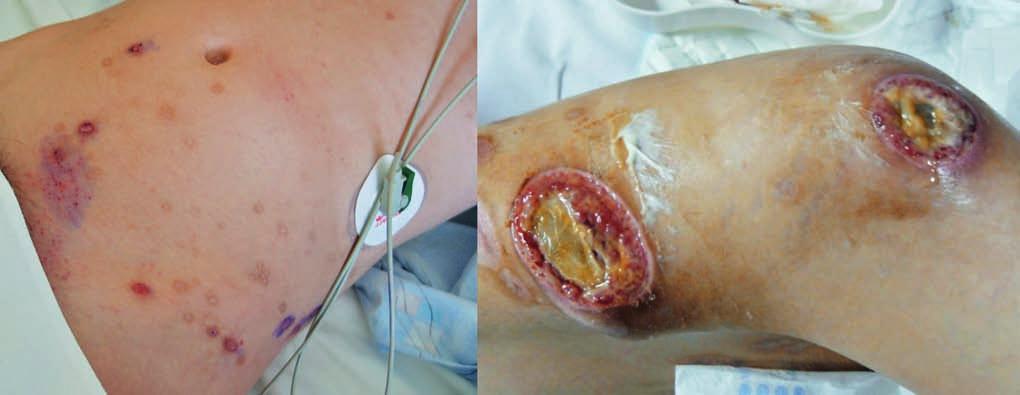 DERMATOLOGIE A OSTATNÍ OBORY KOŽNÍ TOXICITA PROTINÁDOROVÉ LÉČBY Dermatologická toxicita patří mezi nejčastější vedlejší lékové reakce.