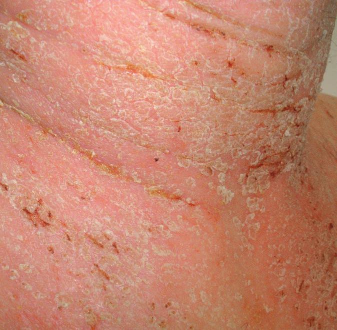 SUCCUS DLOUHODOBÁ LÉČBA EMOLIENTY ZLEPŠUJE SUCHOST KŮŽE U DĚTÍ S ATOPICKOU DERMATITIDOU Atopická dermatitida se manifestuje v 80 % u dětí do pěti let, postihuje asi 18 % dětí.