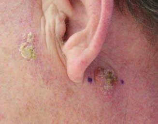 This case study deals with a patient after a kidney transplant, who developed multiple tumours of various histological types, in various, mostly solar localisations.