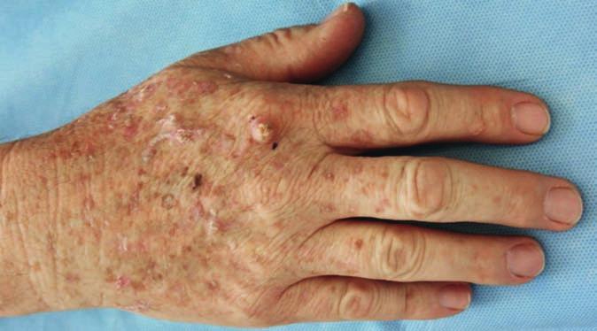 KAZUISTIKA Obr. 5 Nález při klinickém vyšetření pacienta před zahájením léčby vým uchem plak rozměrů 12krát 18 mm růžové barvy, před levým uchem makulu růžové barvy s nánosy šupin 12krát 16 mm (Obr.