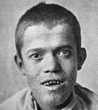 Z HISTORIE ČESKÉ DERMATOVENEROLOGIE Rosacea (druhé stadium) Actinomycosis (lupoidní typ) Lues hereditaria (vrozená syfilis, známky syphilis congenita tarda) Obr. 3 Ukázky obrázků z Dermatologie II.