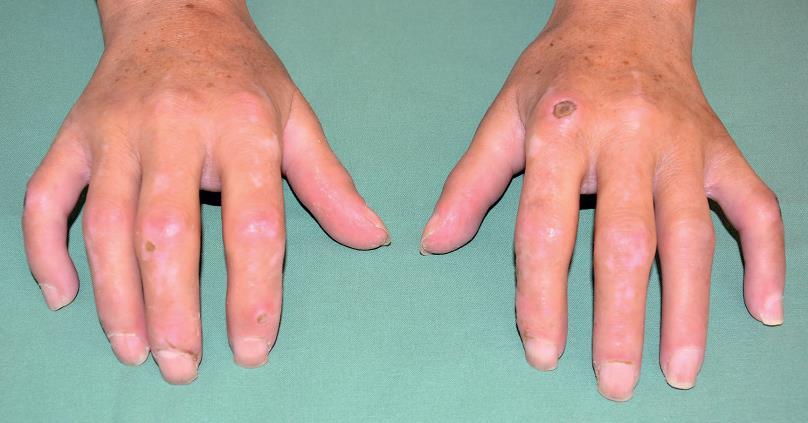 Rizikovými faktory pro vznik malignity jsou ženské pohlaví, vyšší věk a difuzní forma onemocnění (Wooten, 2008).