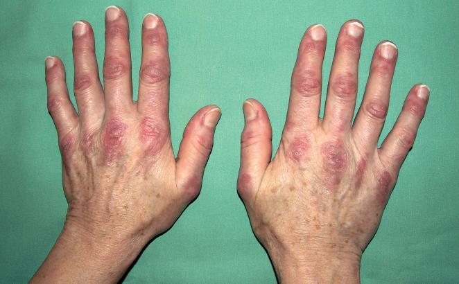 přítomny myalgie, může se objevovat i lehká dysfagie, dyspnoe a zcela ojediněle intersticiální plicní