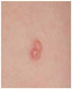 MOLUSKA - MOLLUSCUM CONTAGIOSUM Molluscum contagiosum je povrchová virová infekce kůže způsobená poxviry.