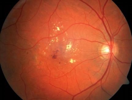 Pr i pokročilé proliferativní diabetické retinopatii dochází ke krvácení na sítnici, odchlípení sítnice a neovaskularizaci na duhovce.
