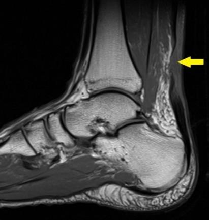Obrázek 14 Ruptura Achillovy šlachy na MRI Zdroj: http://sportsmedicinenewyork.